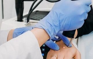 начини за премахване на брадавици