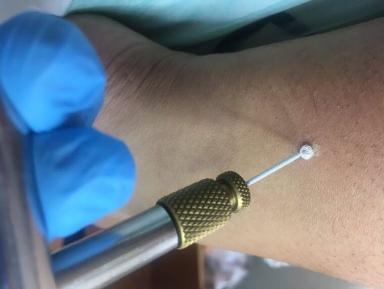 начини за премахване на брадавици