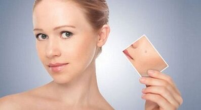 преглед на ефективни лекарства за брадавици и папиломи